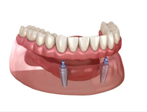 livonia dental implants