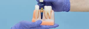 livonia implant and crown
