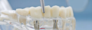livonia dental implant bridge