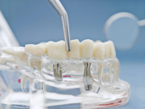 livonia dental implant bridge