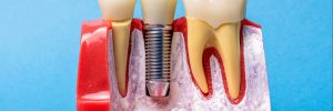 livonia dental implants