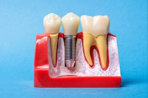livonia dental implants